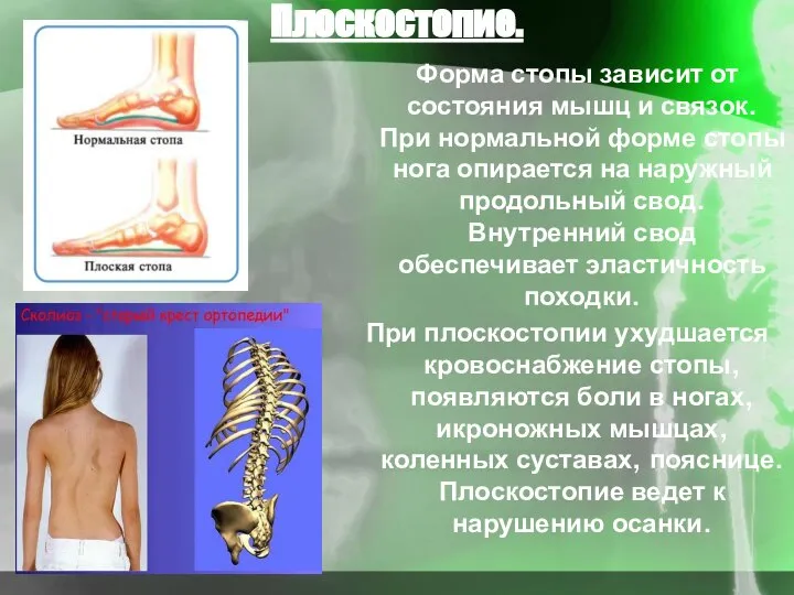 Плоскостопие. Форма стопы зависит от состояния мышц и связок. При нормальной