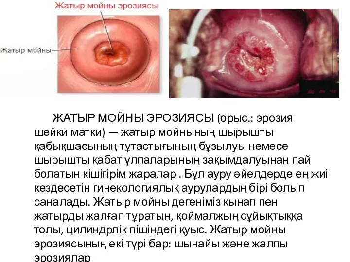 ЖАТЫР МОЙНЫ ЭРОЗИЯСЫ (орыс.: эрозия шейки матки) — жатыр мойнының шырышты