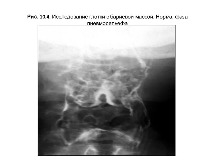 Рис. 10.4. Исследование глотки с бариевой массой. Норма, фаза пневморельефа