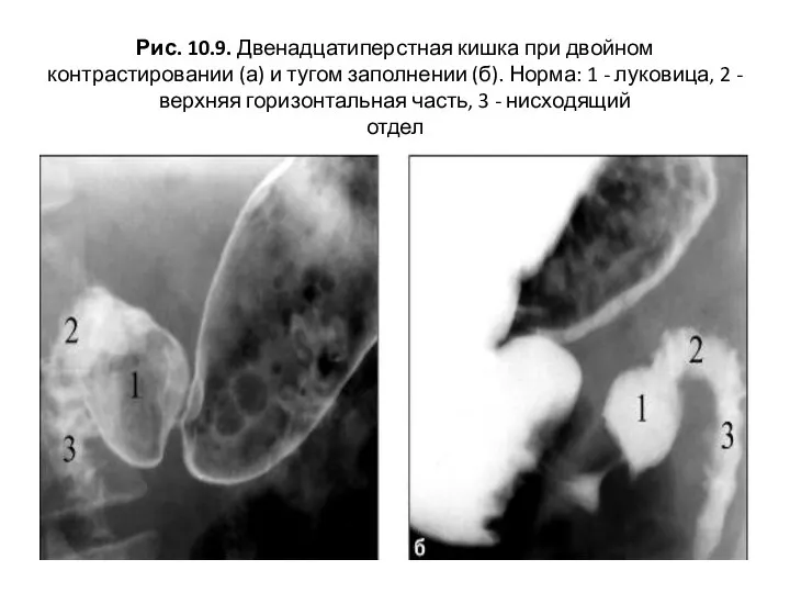 Рис. 10.9. Двенадцатиперстная кишка при двойном контрастировании (а) и тугом заполнении