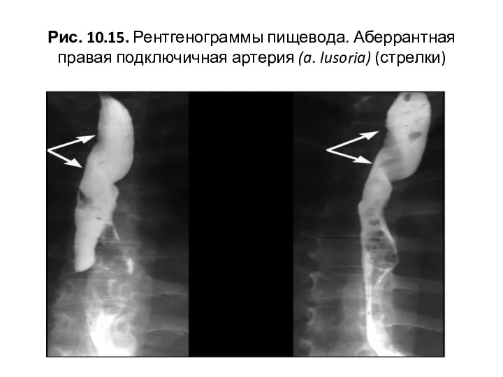 Рис. 10.15. Рентгенограммы пищевода. Аберрантная правая подключичная артерия (a. lusoria) (стрелки)
