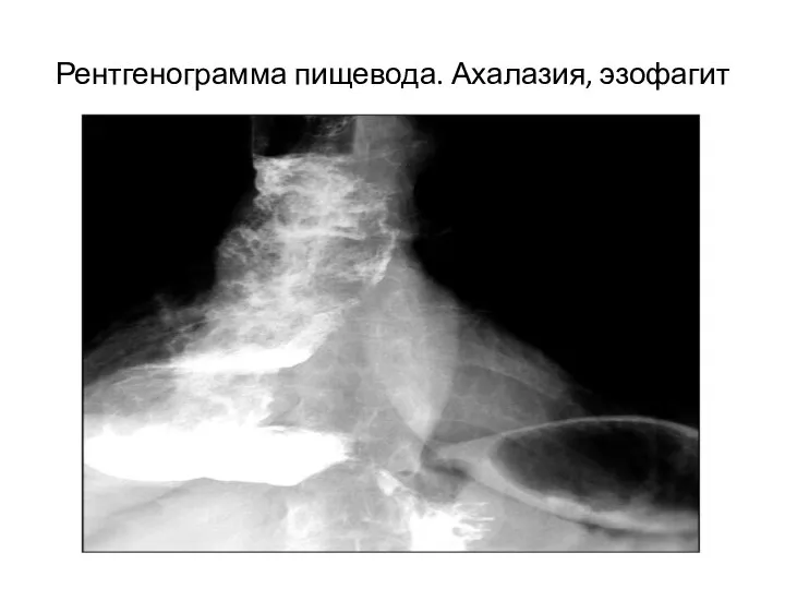 Рентгенограмма пищевода. Ахалазия, эзофагит