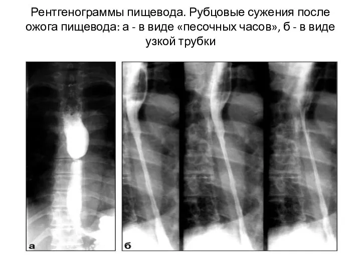 Рентгенограммы пищевода. Рубцовые сужения после ожога пищевода: а - в виде