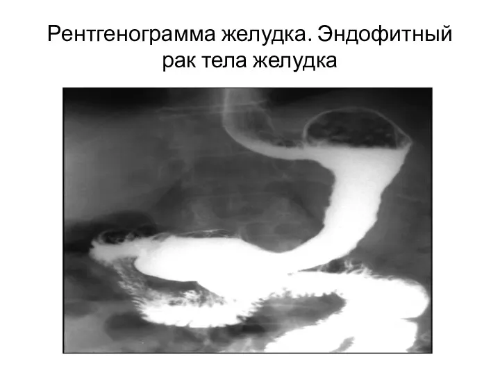 Рентгенограмма желудка. Эндофитный рак тела желудка