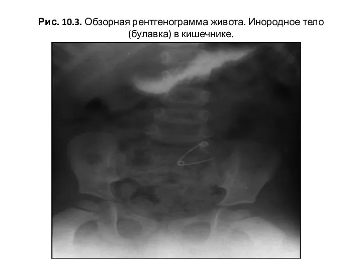 Рис. 10.3. Обзорная рентгенограмма живота. Инородное тело (булавка) в кишечнике.