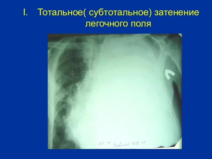 Тотальное( субтотальное) затенение легочного поля