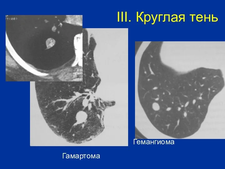 Гамартома Гемангиома III. Круглая тень