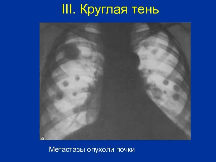 Метастазы опухоли почки III. Круглая тень