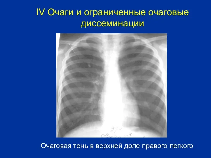 Очаговая тень в верхней доле правого легкого IV Очаги и ограниченные очаговые диссеминации