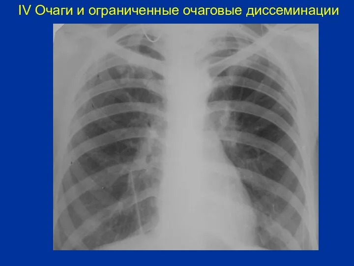 IV Очаги и ограниченные очаговые диссеминации