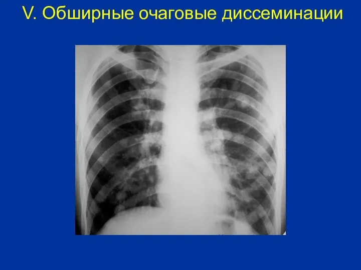 V. Обширные очаговые диссеминации