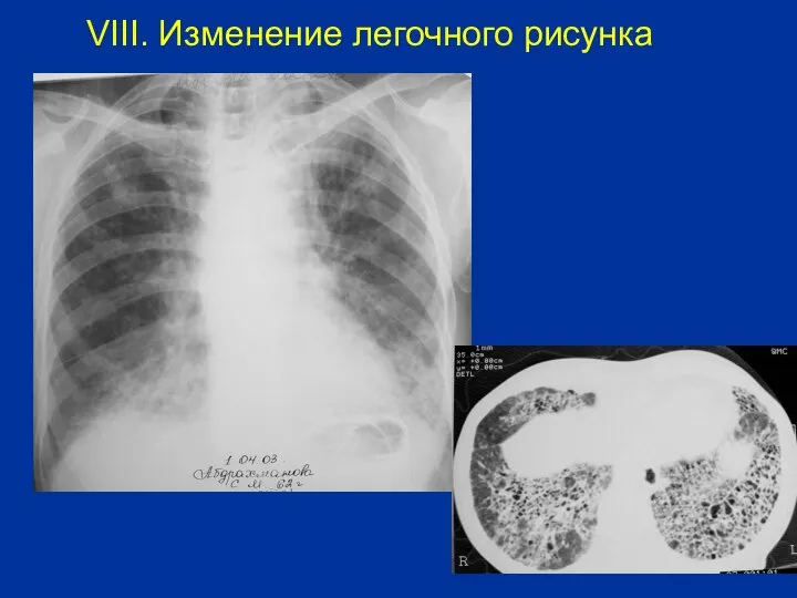 VIII. Изменение легочного рисунка