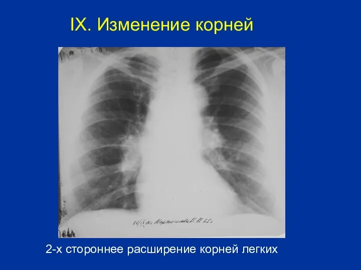 2-х стороннее расширение корней легких IX. Изменение корней