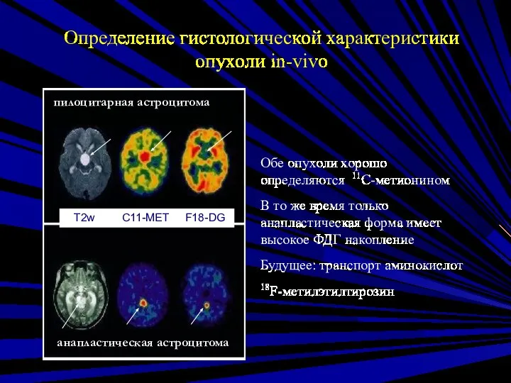 Определение гистологической характеристики опухоли in-vivo Обе опухоли хорошо определяются 11C-метионином В