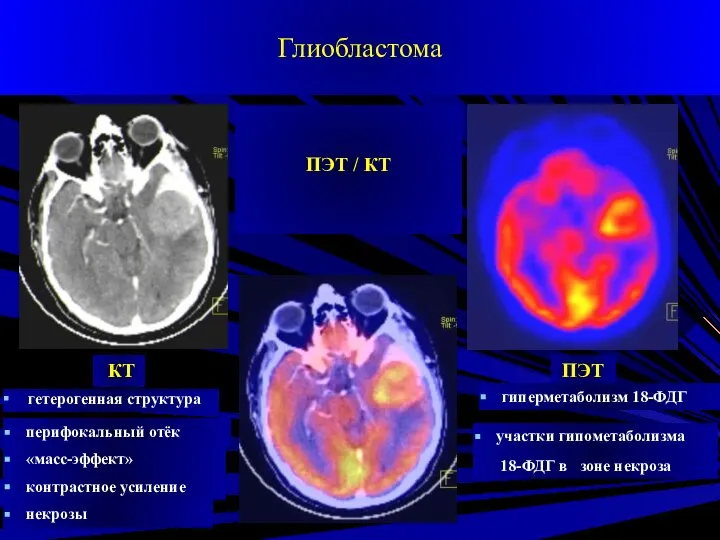 ПЭТ / КТ Глиобластома КТ ПЭТ гетерогенная структура перифокальный отёк «масс-эффект»