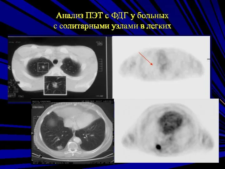 Анализ ПЭТ с ФДГ у больных с солитарными узлами в легких