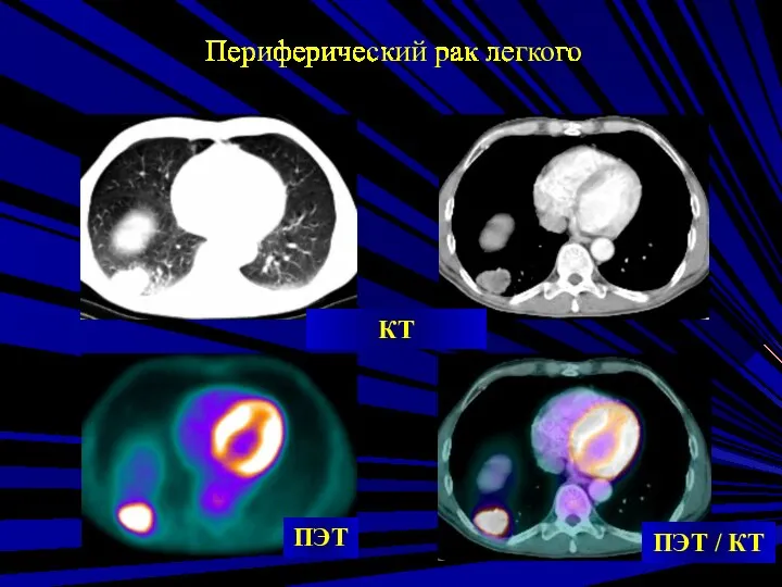 КТ ПЭТ / КТ ПЭТ Периферический рак легкого