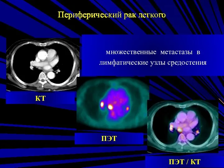 ПЭТ КТ ПЭТ / КТ множественные метастазы в лимфатические узлы средостения Периферический рак легкого