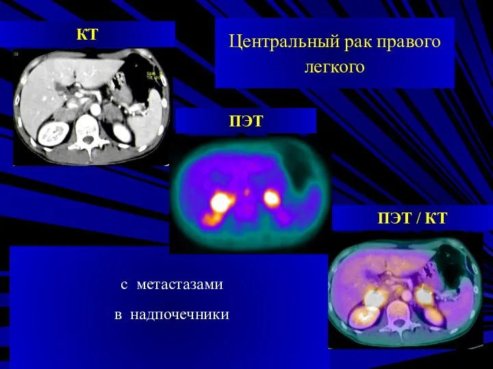 Центральный рак правого легкого ПЭТ / КТ ПЭТ КТ с метастазами в надпочечники