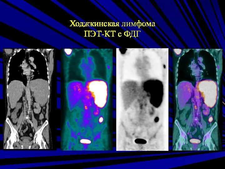 Ходжкинская лимфома ПЭТ-КТ с ФДГ
