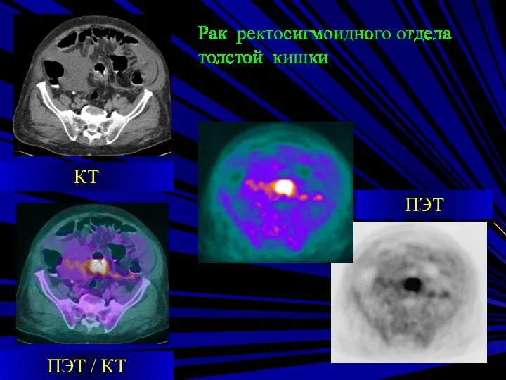 Рак ректосигмоидного отдела толстой кишки ПЭТ КТ ПЭТ / КТ