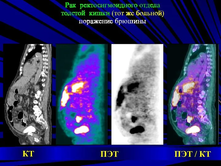 Рак ректосигмоидного отдела толстой кишки (тот же больной) поражение брюшины ПЭТ КТ ПЭТ / КТ