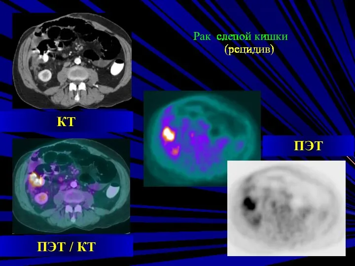 Рак слепой кишки (рецидив) ПЭТ КТ ПЭТ / КТ