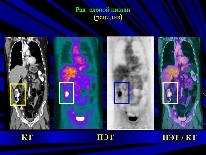 Рак слепой кишки (рецидив) ПЭТ КТ ПЭТ / КТ