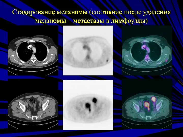 Стадирование меланомы (состояние после удаления меланомы – метастазы в лимфоузлы)