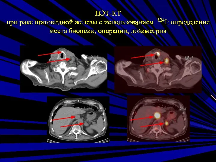 ПЭТ-КТ при раке щитовидной железы с использованием 124I: определение места биопсии, операции, дозиметрия