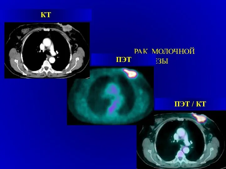 РАК МОЛОЧНОЙ ЖЕЛЕЗЫ ПЭТ КТ ПЭТ / КТ