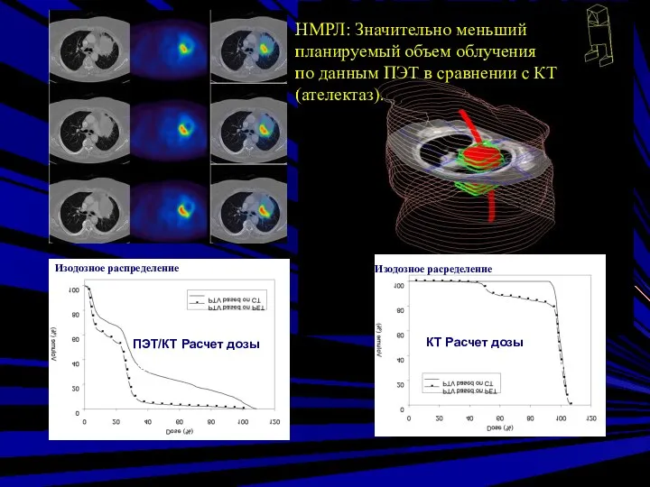 PET- Plan DVH of lung DVH of PTV CT- Plan НМРЛ: