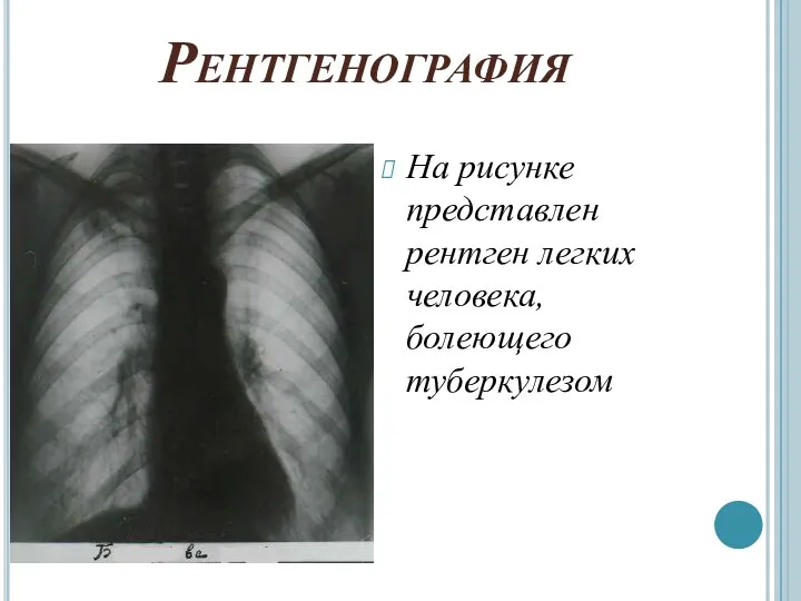 Рентгенография На рисунке представлен рентген легких человека, болеющего туберкулезом