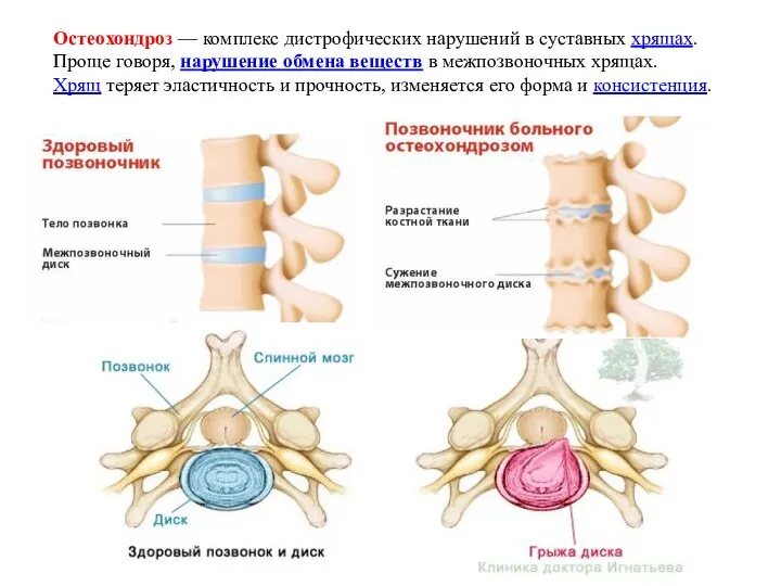 Остеохондроз — комплекс дистрофических нарушений в суставных хрящах. Проще говоря, нарушение