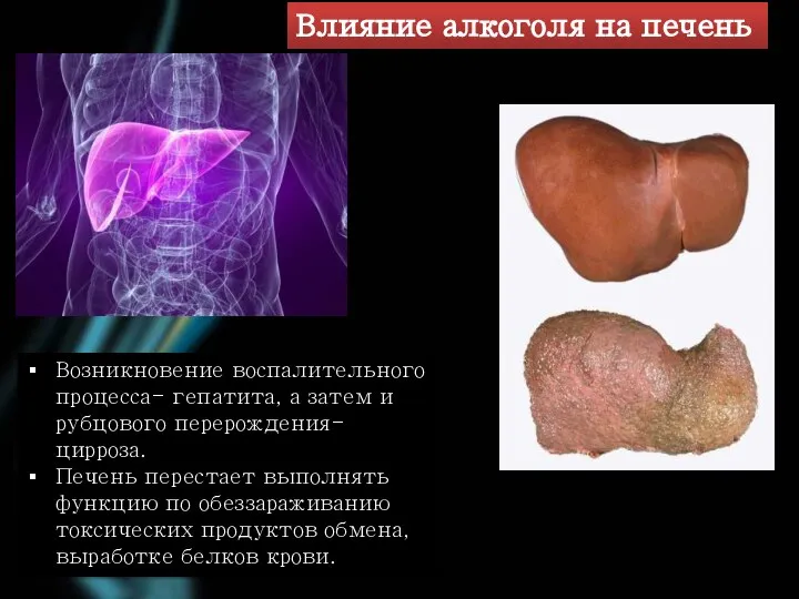 Возникновение воспалительного процесса- гепатита, а затем и рубцового перерождения-цирроза. Печень перестает