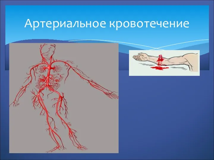 Артериальное кровотечение