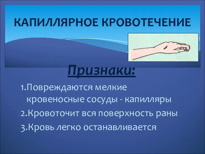 Признаки: 1.Повреждаются мелкие кровеносные сосуды - капилляры 2.Кровоточит вся поверхность раны 3.Кровь легко останавливается КАПИЛЛЯРНОЕ КРОВОТЕЧЕНИЕ