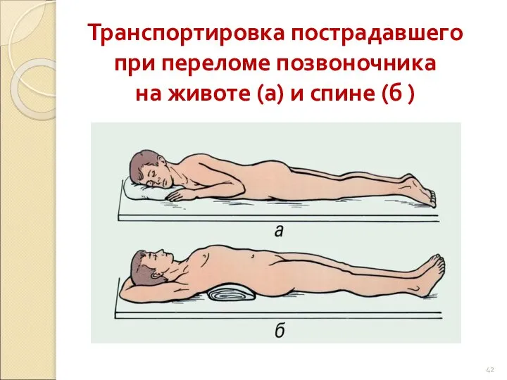 Транспортировка пострадавшего при переломе позвоночника на животе (а) и спине (б )