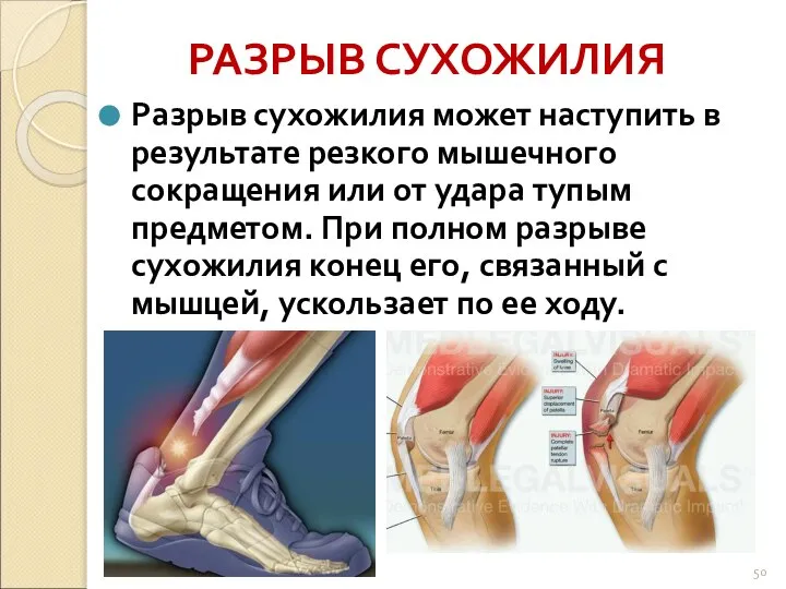 РАЗРЫВ СУХОЖИЛИЯ Разрыв сухожилия может наступить в результате резкого мышечного сокращения