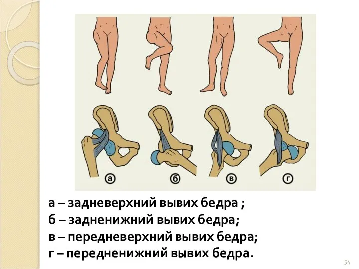 а – задневерхний вывих бедра ; б – задненижний вывих бедра;