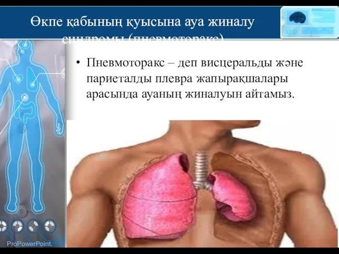 Өкпе қабының қуысына ауа жиналу синдромы (пневмоторакс) Пневмоторакс – деп висцеральды