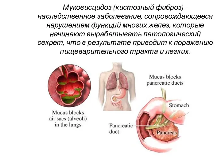 Муковисцидоз (кистозный фиброз) - наследственное заболевание, сопровождающееся нарушением функций многих желез,