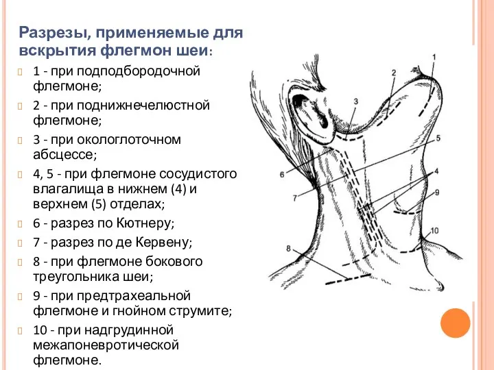 Разрезы, применяемые для вскрытия флегмон шеи: 1 - при подподбородочной флегмоне;