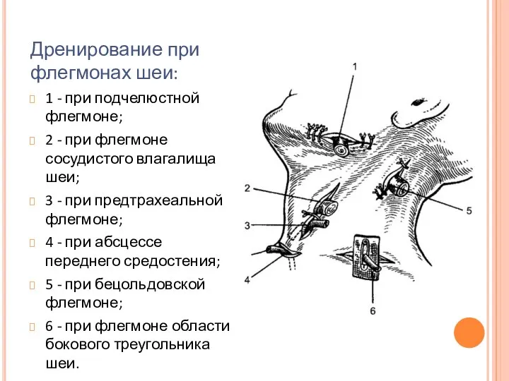 Дренирование при флегмонах шеи: 1 - при подчелюстной флегмоне; 2 -