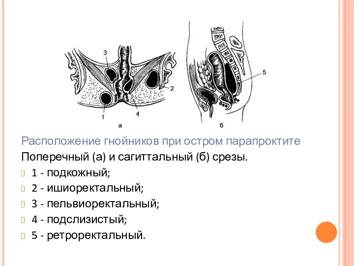 Расположение гнойников при остром парапроктите Поперечный (а) и сагиттальный (б) срезы.