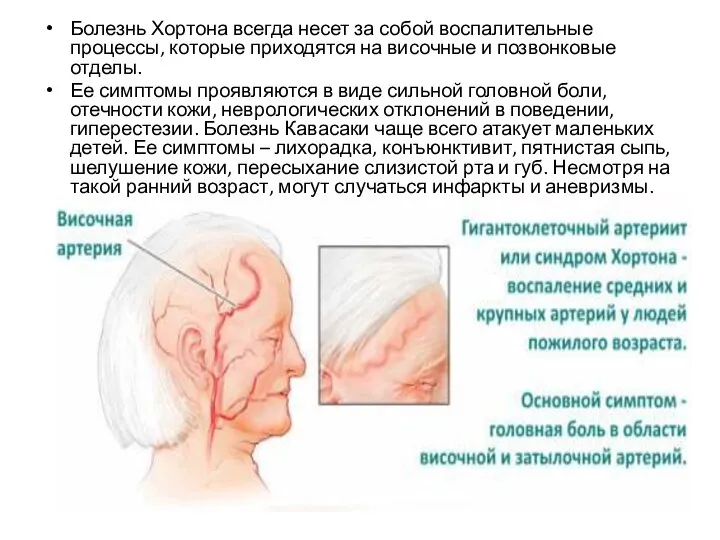 Болезнь Хортона всегда несет за собой воспалительные процессы, которые приходятся на