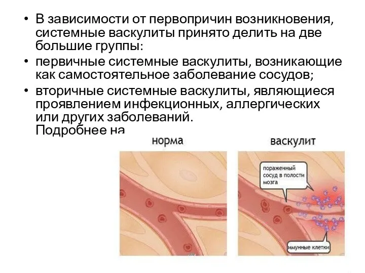 В зависимости от первопричин возникновения, системные васкулиты принято делить на две