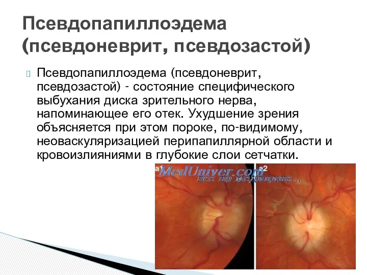 Псевдопапиллоэдема (псевдоневрит, псевдозастой) - состояние специфического выбухания диска зрительного нерва, напоминающее