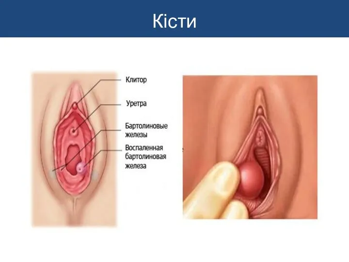 Кісти