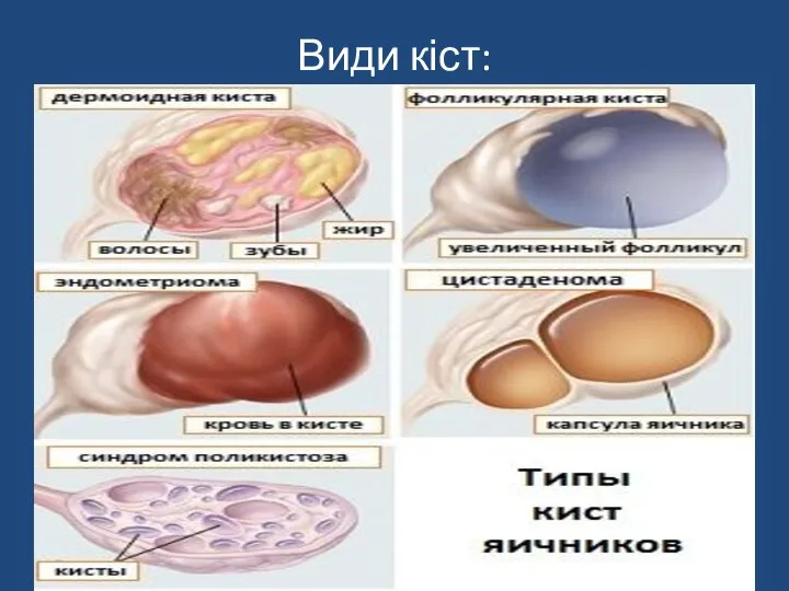 Види кіст: